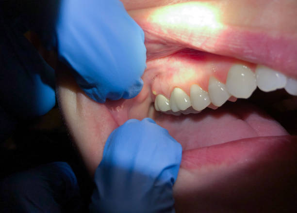 Best Cracked Tooth Emergency Dentist  in Milam, TX