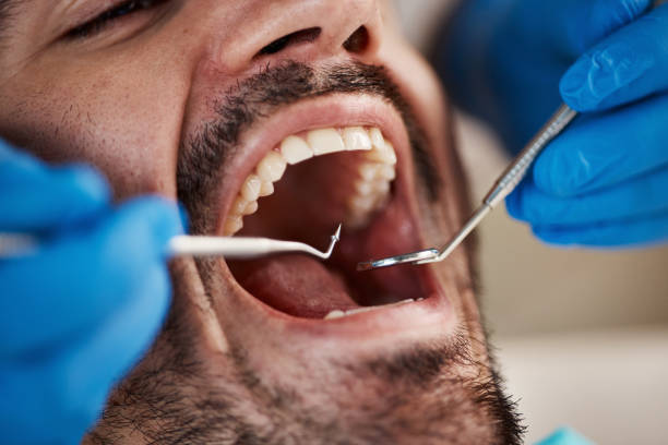 Best Chipped Tooth Repair Near Me  in Milam, TX